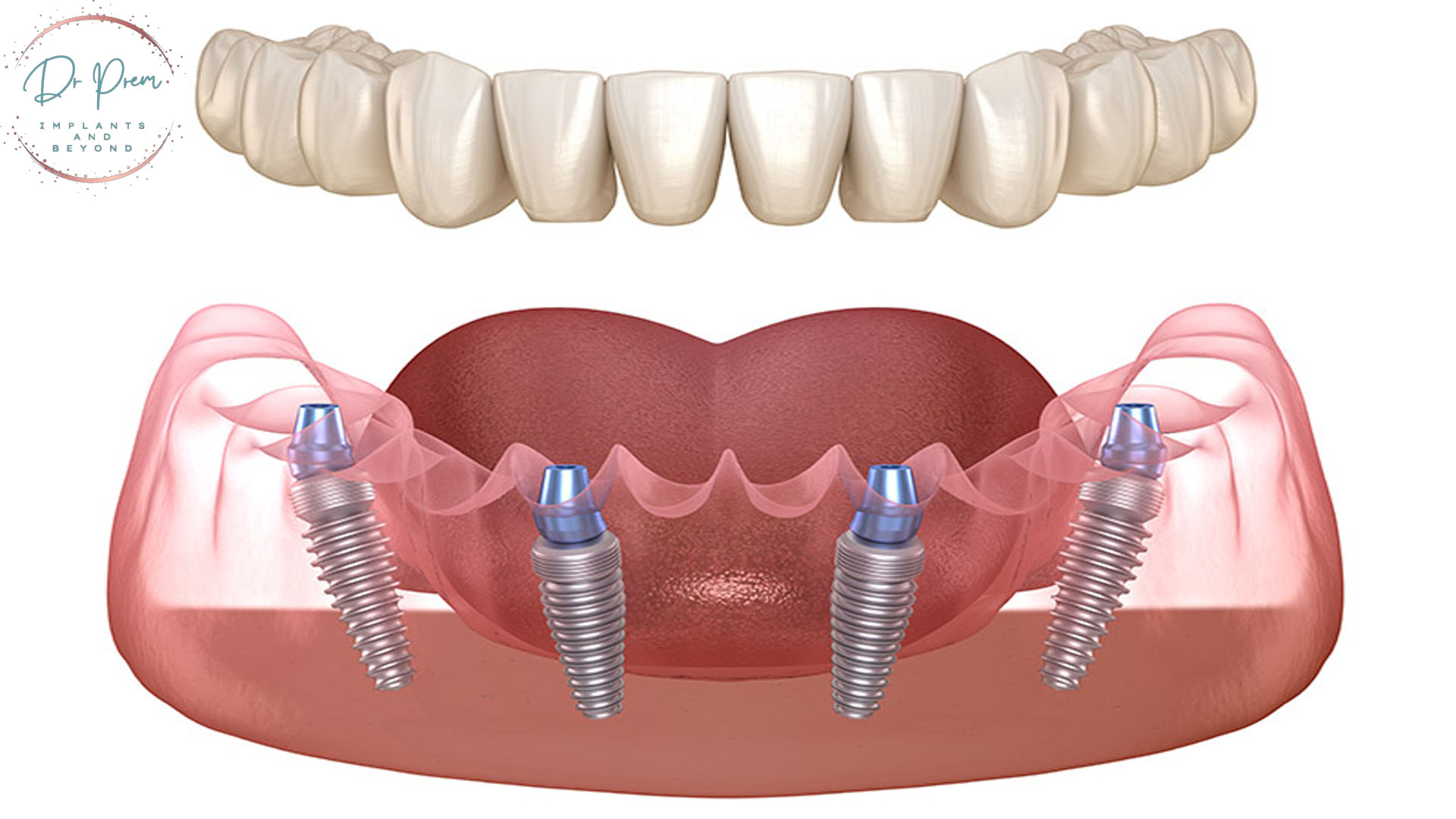 The ABCs of Dental Implants: A Comprehensive Guide (Doctorprem)