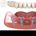 Group photo of The ABCs of Dental Implants: A Comprehensive Guide (Doctorprem)